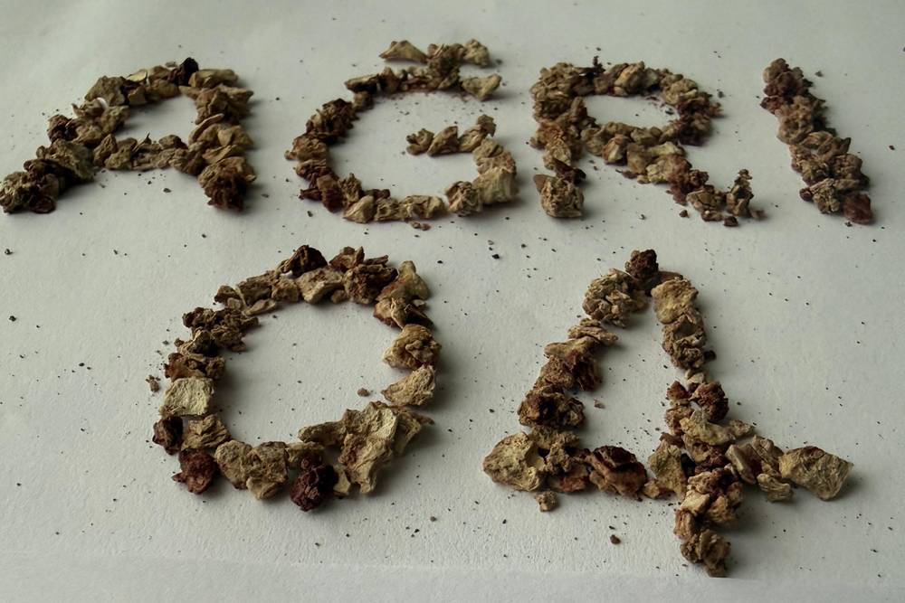 295 Taşın Çıkarıldığı Ameliyatla Abdurrahman B. Rahatladı!