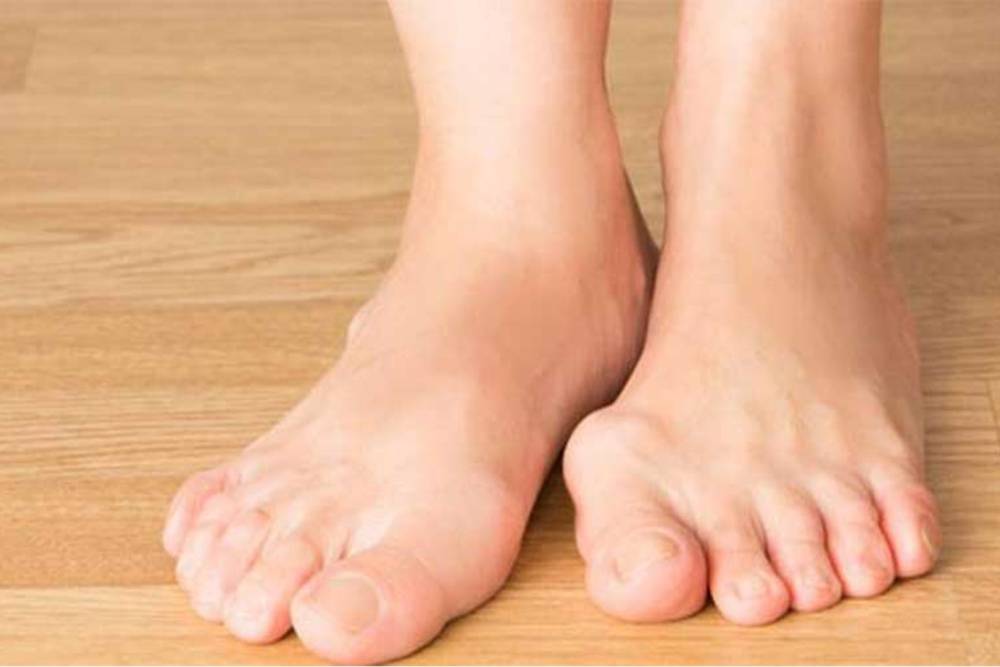 Halluks valgus yaşam kalitesini &ouml;nemli &ouml;l&ccedil;&uuml;de etkileyebilir