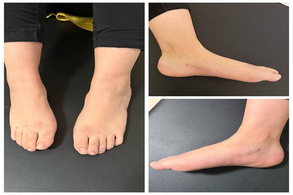 Şanlıurfa&rsquo;da milyonda bir g&ouml;r&uuml;len hastalıkta umut veren başarı